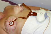A self–adhesive, 12 petal array of electrodes is applied to the breast to measure bioimpedance